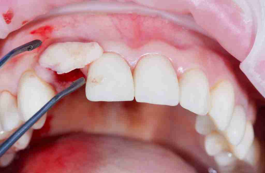Dental Bone Graft